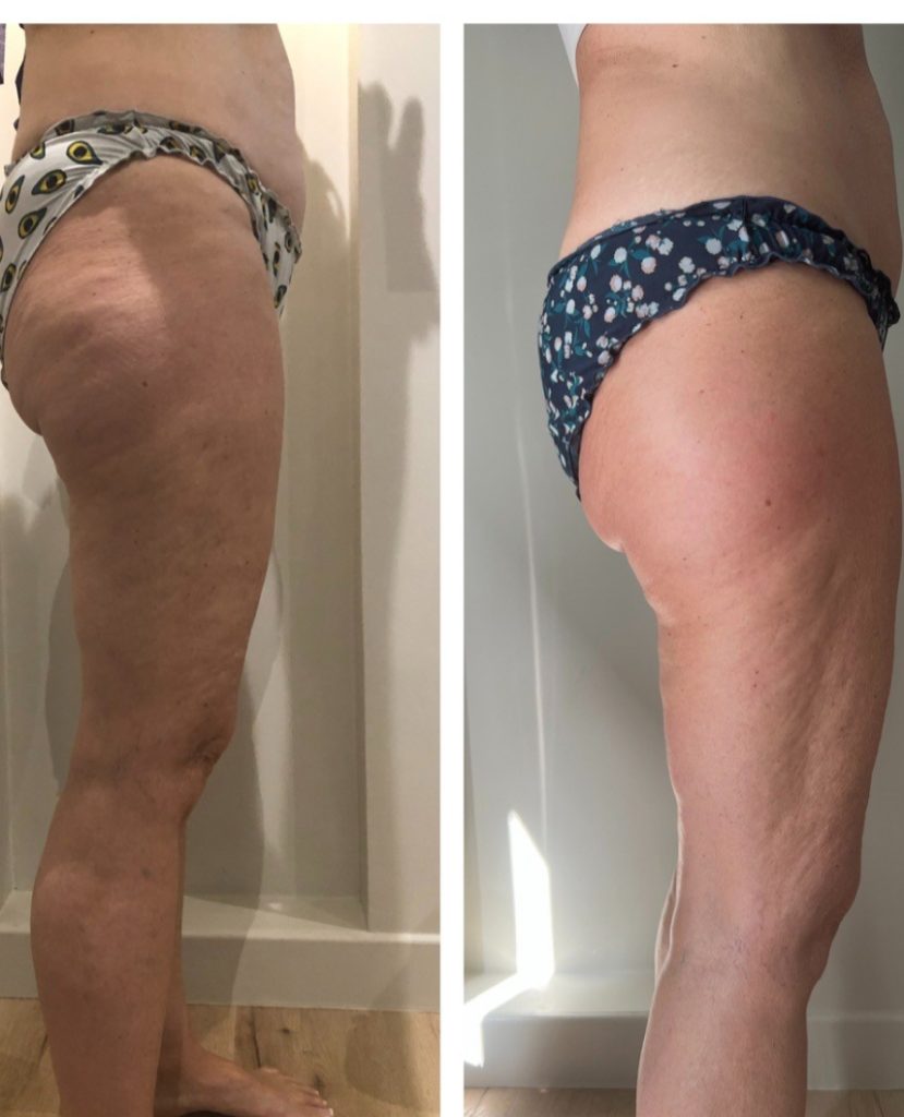 schéma technique du remodelage renata frança, méthode brésilienne.
